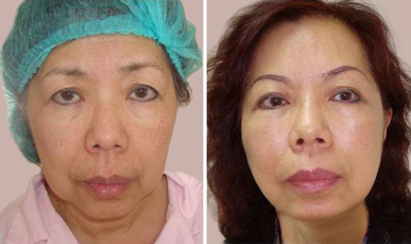 Hướng dẫn chi tiết về phẫu thuật căng da mặt và lợi ích của nó