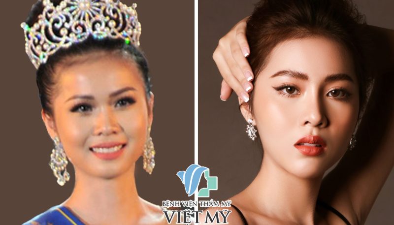 Tự tin với nâng mũi sụn tự thân: Tìm hiểu về quá trình và lợi ích của phương pháp này