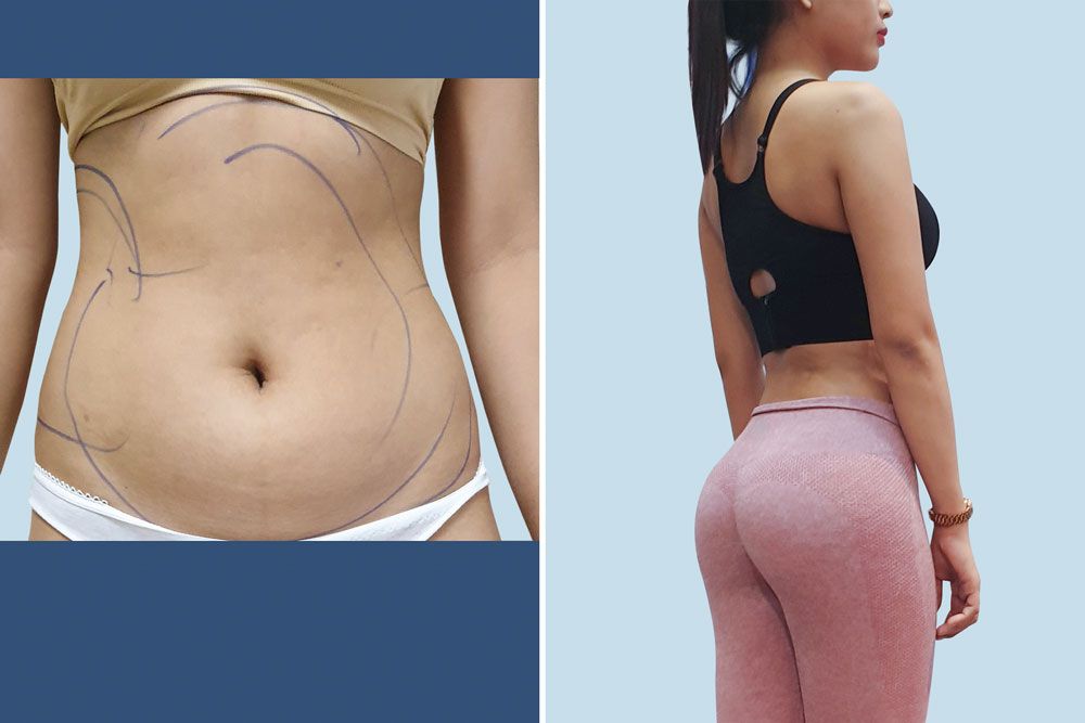 Giảm Mỡ Toàn Thân Hiệu Quả Với Công Nghệ Thẩm Mỹ Hiện Đại