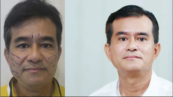 Bao nhiêu tuổi nên căng da mặt?