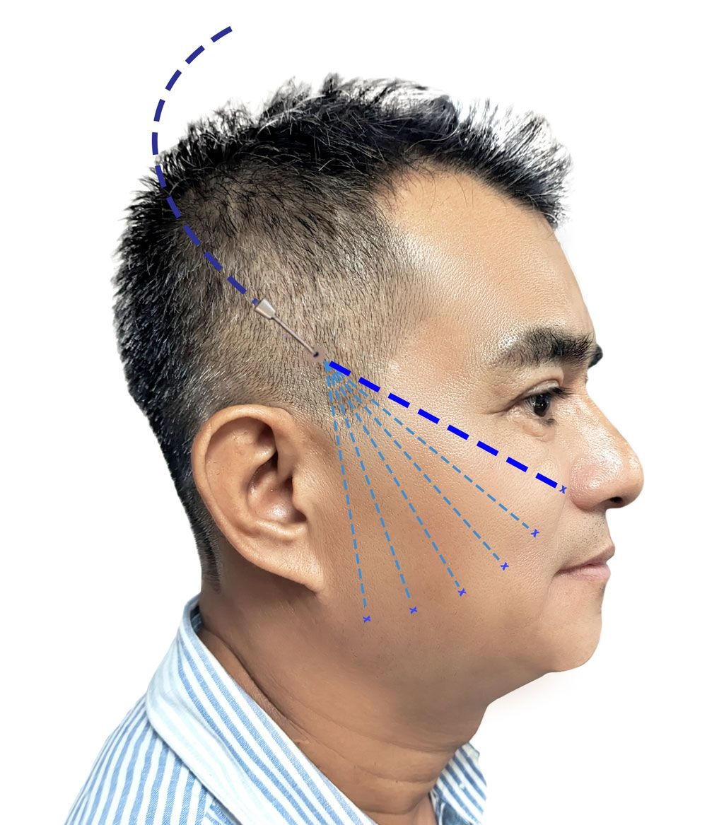 Hút mỡ mặt Giải pháp hoàn hảo cho gương mặt thon gọn và thu hút