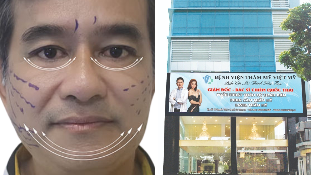 Case thực tế tại Bệnh viện Thẩm mỹ Việt Mỹ 