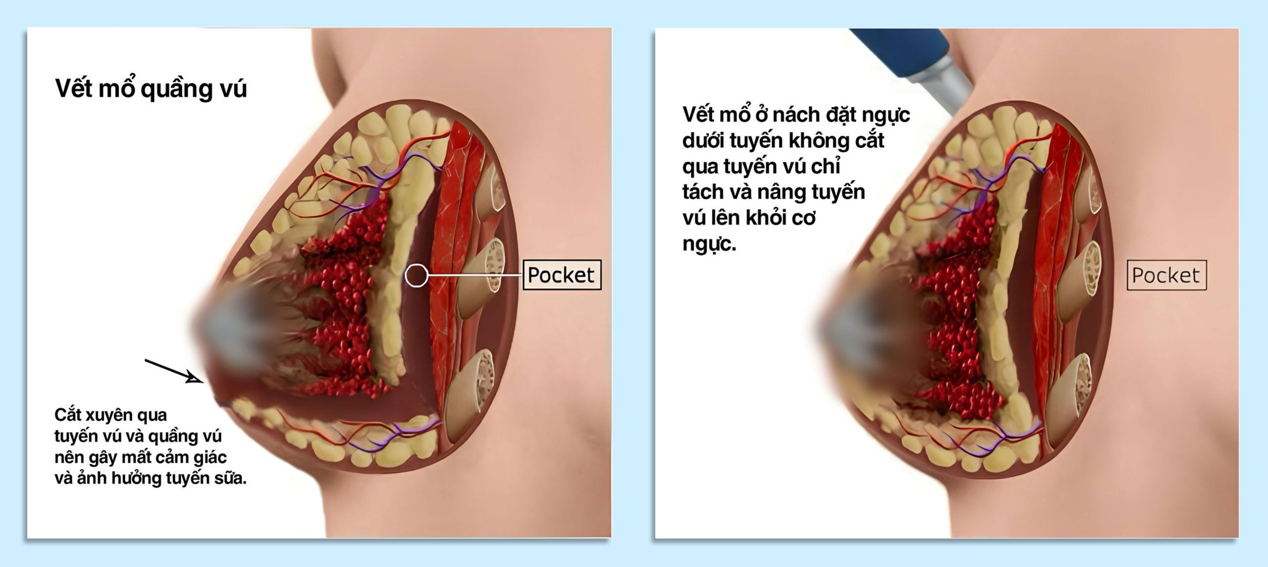 Bác sĩ tư vấn lựa chọn túi nâng ngực phù hợp với dáng người và nền ngực của khách hàng