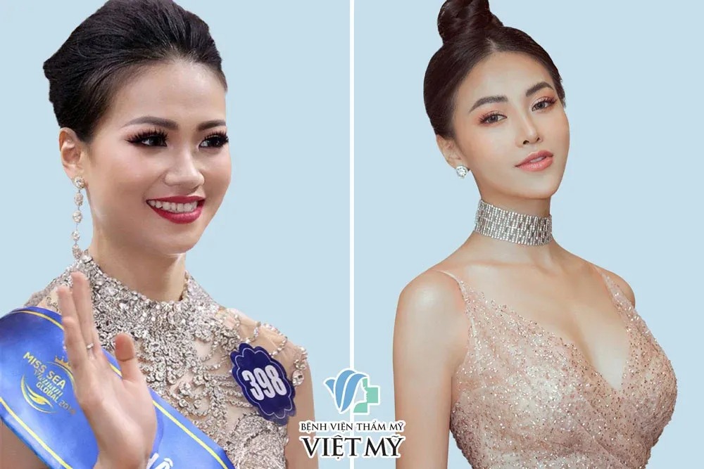Hình ảnh trước và sau nâng ngực dáng cao tại Bệnh viện Thẩm mỹ Việt Mỹ