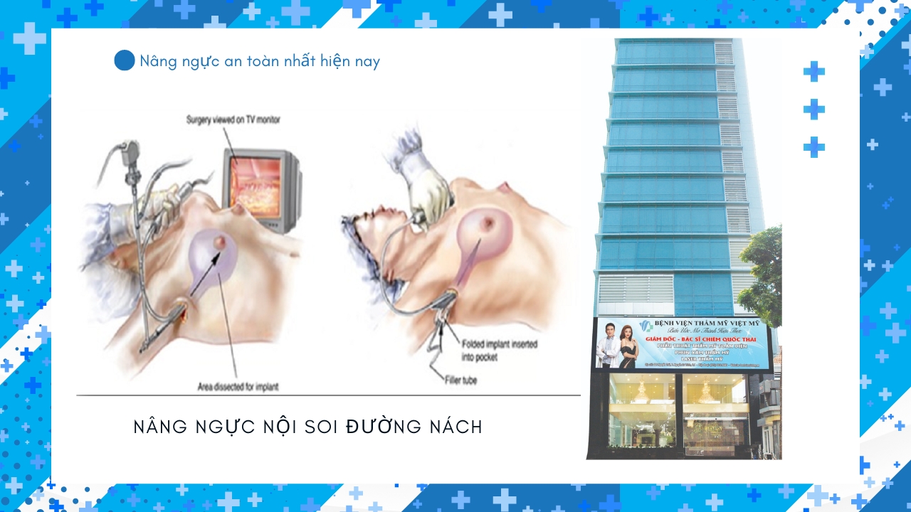 Nâng ngực an toàn: Tiêu chí chọn bác sĩ, phương pháp và lưu ý trước phẫu thuật Nang nguc an toan nhat hien nay Bs Thai