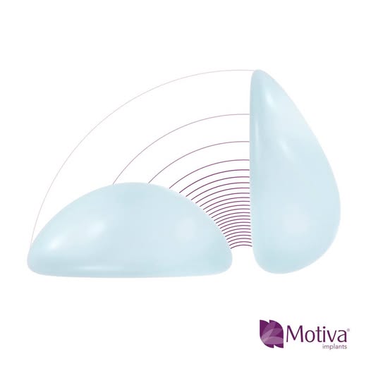 Ra mắt túi ngực Motiva Ergonomix 2 thế hệ mới