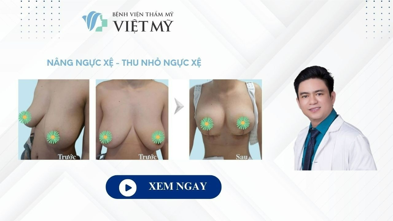 Nâng ngực sa trễ có cần đặt túi không