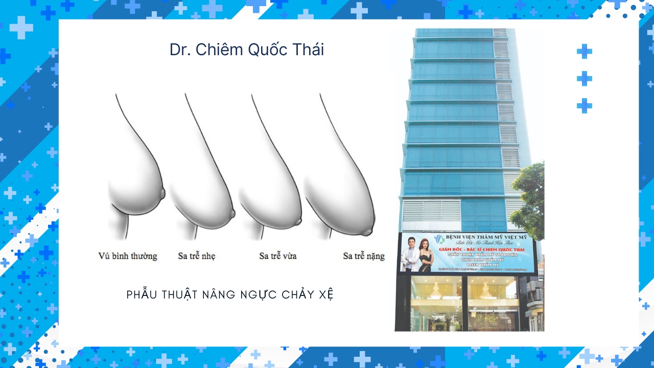 Bác sĩ đánh giá mức độ ngực sa trễ trước phẫu thuật