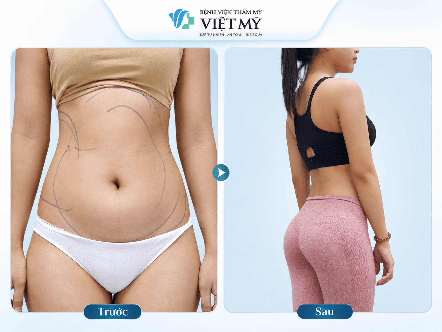 Trang chủ V3.2 Hút mỡ