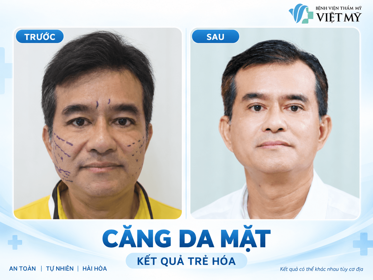 Trang chủ V3.2 Căng da mặt