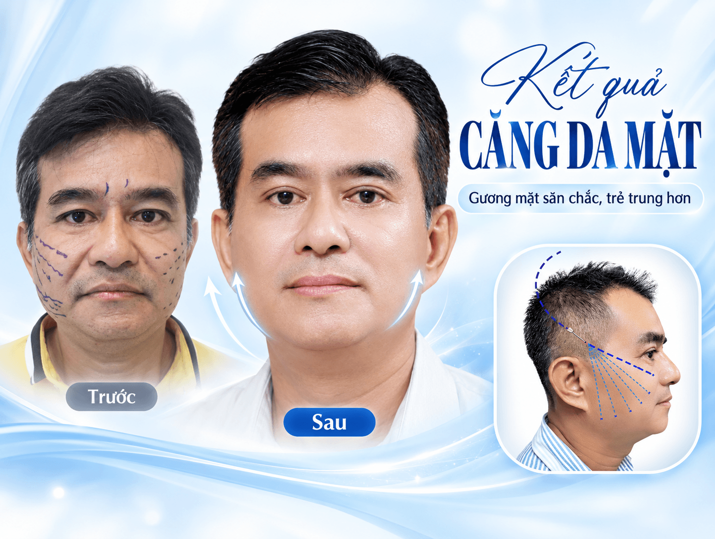 Căng da mặt
