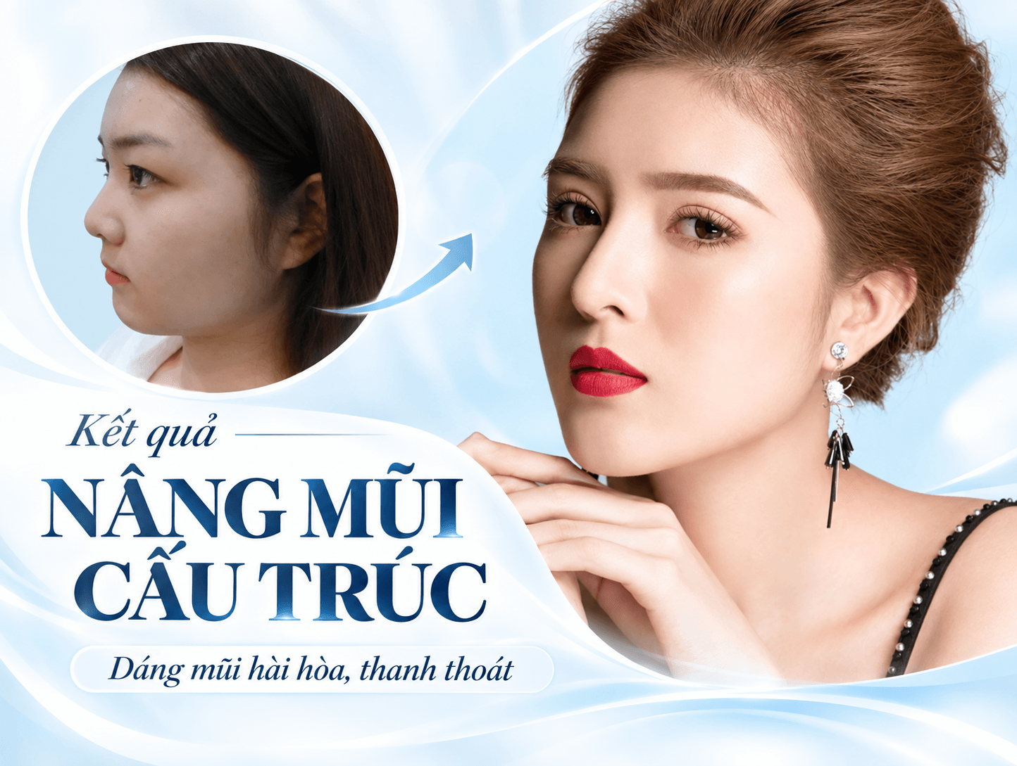 Nâng mũi cấu trúc