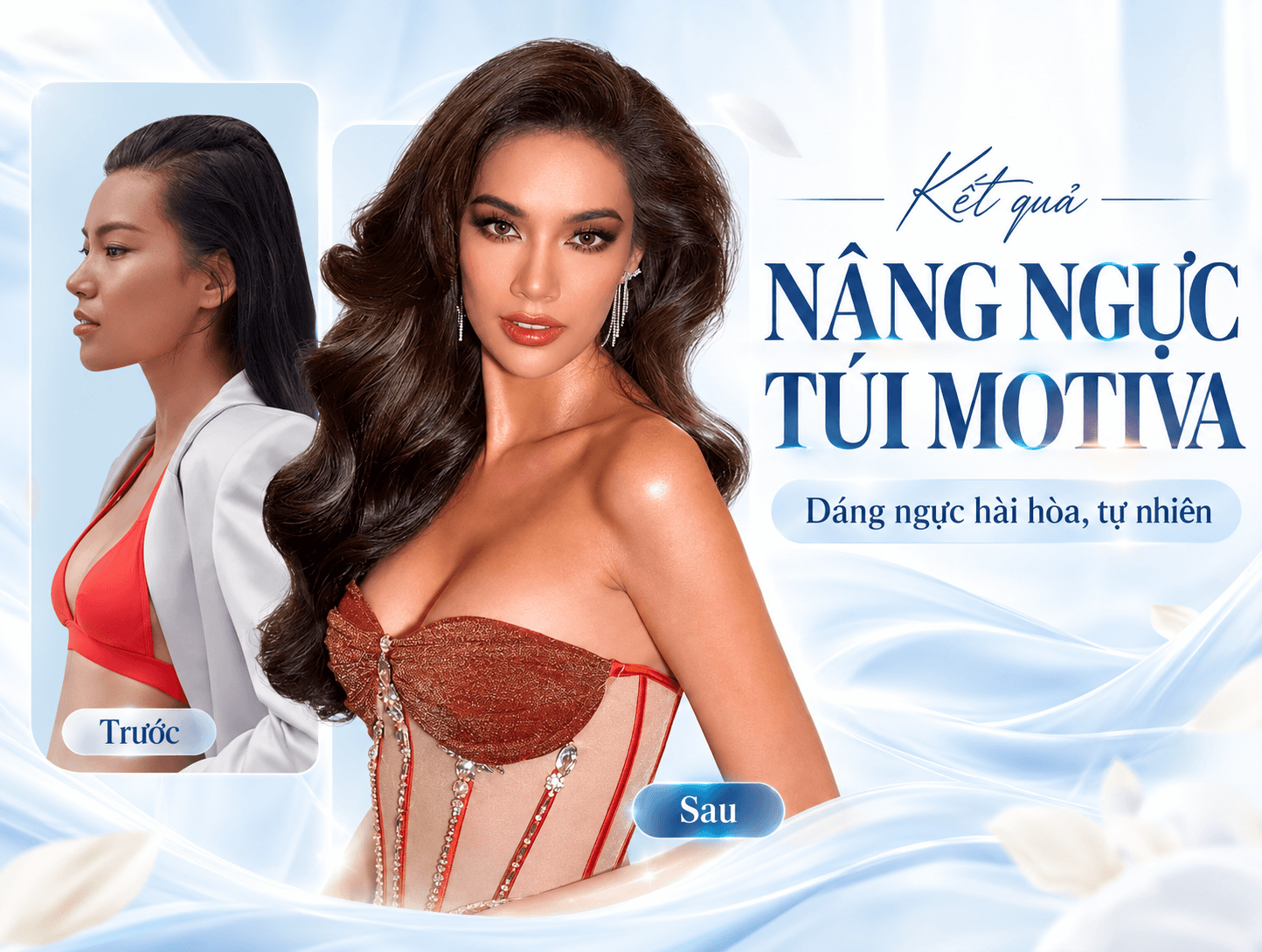 Nâng ngực Motiva
