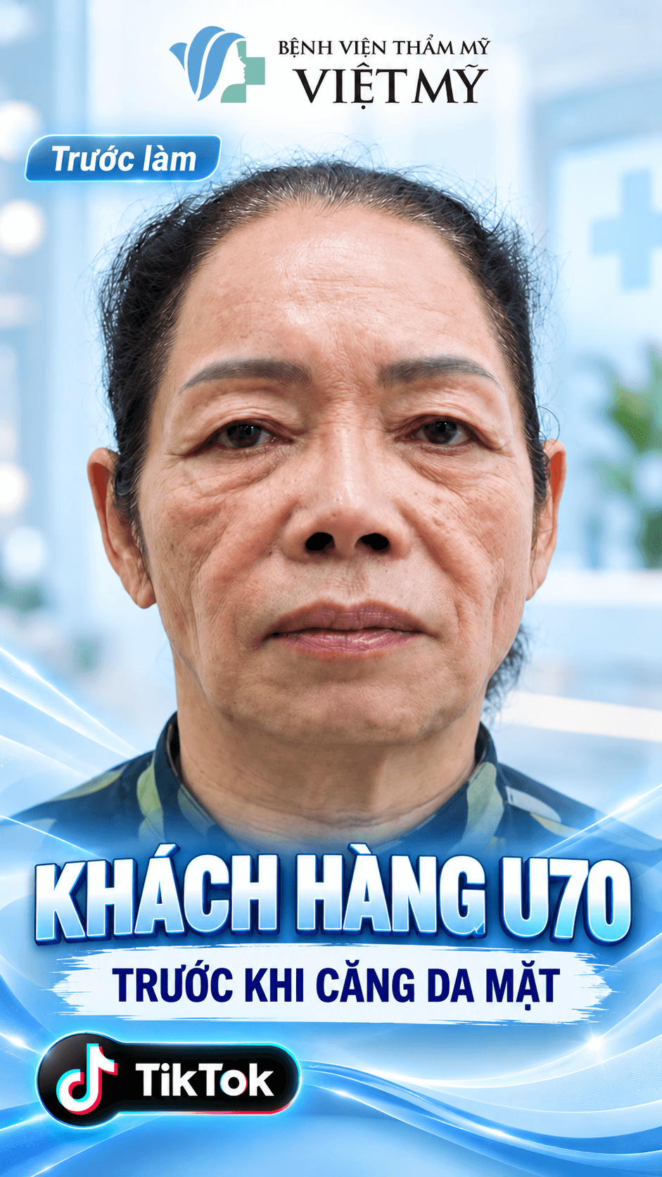 Khách hàng U70 trước khi căng da mặt tại Bệnh viện Thẩm mỹ Việt Mỹ