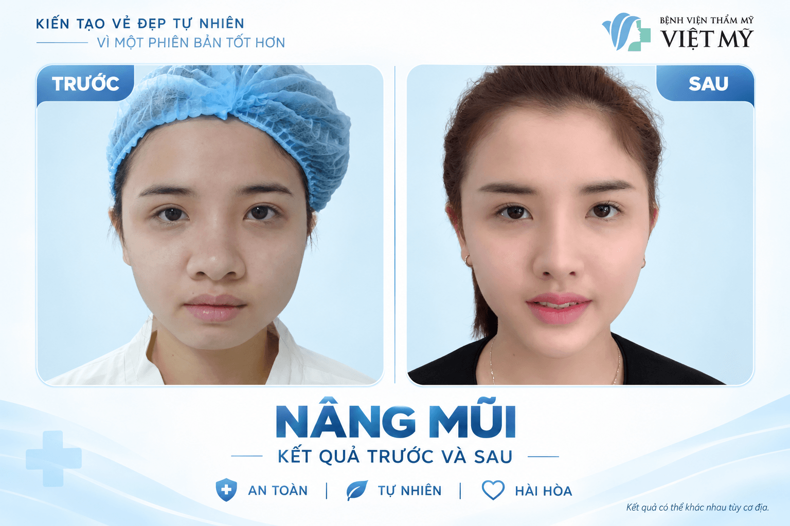 Trang chủ V3.2 Nâng mũi cấu trúc